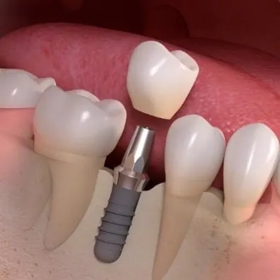 Dental implant supporting a replacement tooth